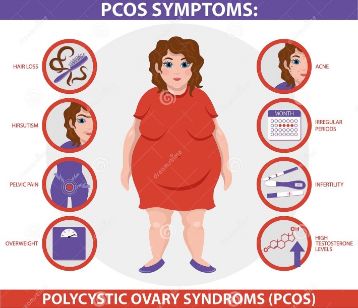 Understanding PCOS – the most common hormonal disorder among women of reproductive age -Seychelles Nation