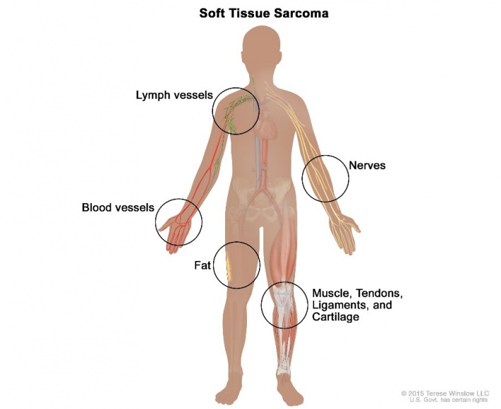 Sarcoma – the ‘forgotten cancer’