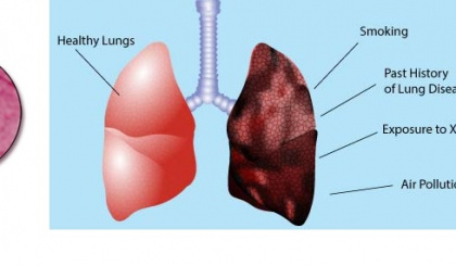 Lung Cancer: Q&A with Dr. Todorovic