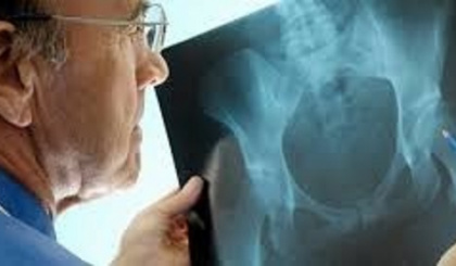 Osteoporosis: Q&A with Dr Todorovic