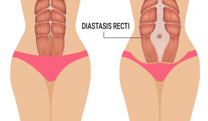 Understanding and promoting healing for Diastasis Recti