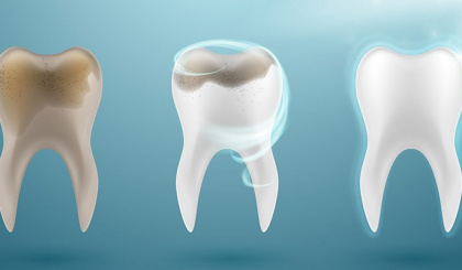 Dental care: Tooth discolouration: causes, prevention and treatment