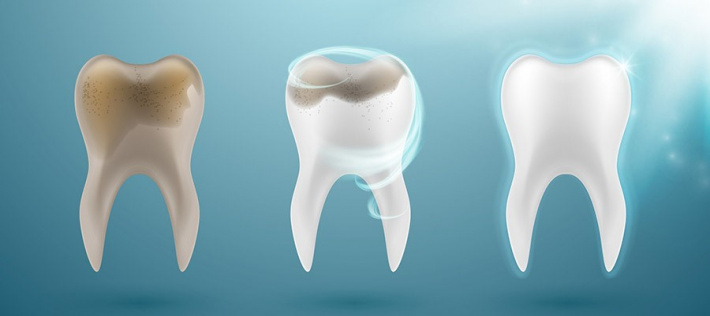 Dental care: Tooth discolouration: causes, prevention and treatment