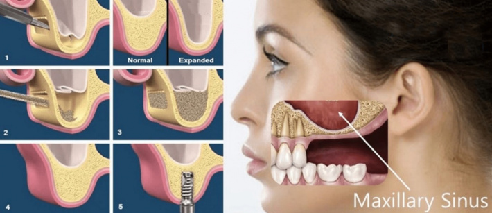 Dentistry: Implantology – current techniques