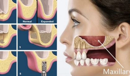 Dentistry: Implantology – current techniques