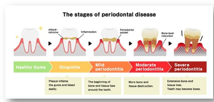 UNDERSTANDING THE IMPACT OF PERIODONTAL DISEASES ON GENERAL HEALTH