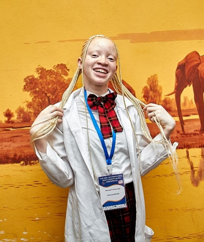 Hope for people with albinism as younginnovator develops organic sunscreen